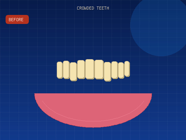 Before — Severely Crowded Teeth